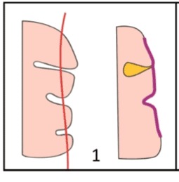 Вот так миндалины запечатывают