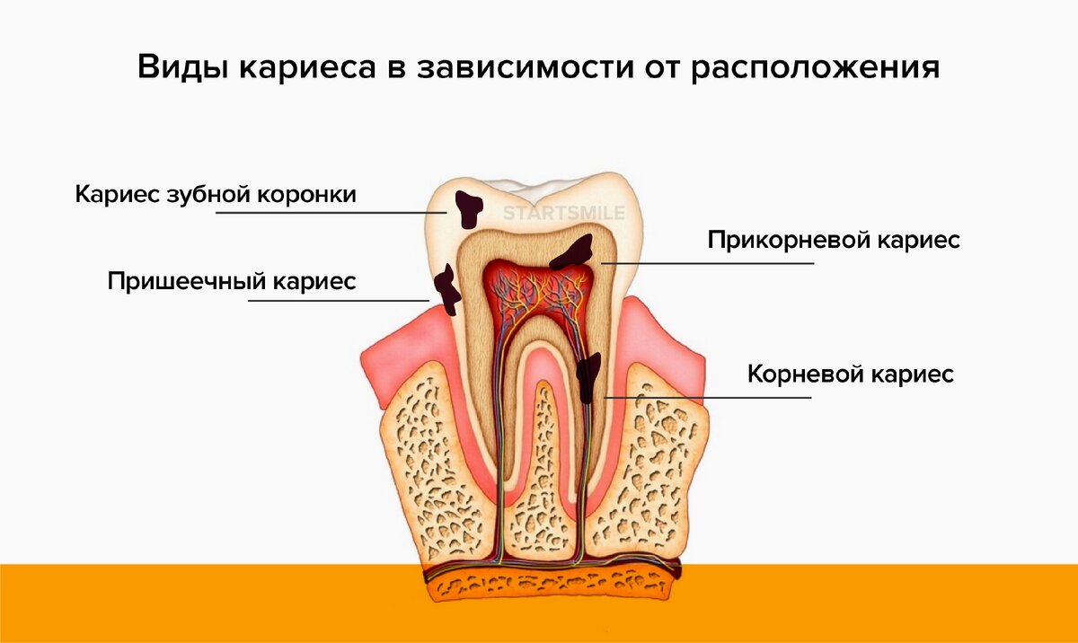 Виды кариеса зубов с картинками