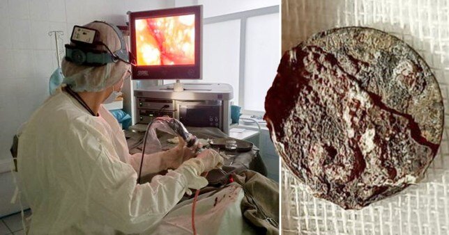 Мужчине удалили монету из носа через 53 года после того, как в детстве воткнули ее в ноздрю 