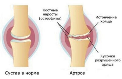 Артроз плечевого сустава - лечение и симптомы, диагностика | Клиника доктора Длина