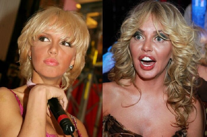 на фото Маша Малиновская до и после операции. источник фото: яндекс картинки.