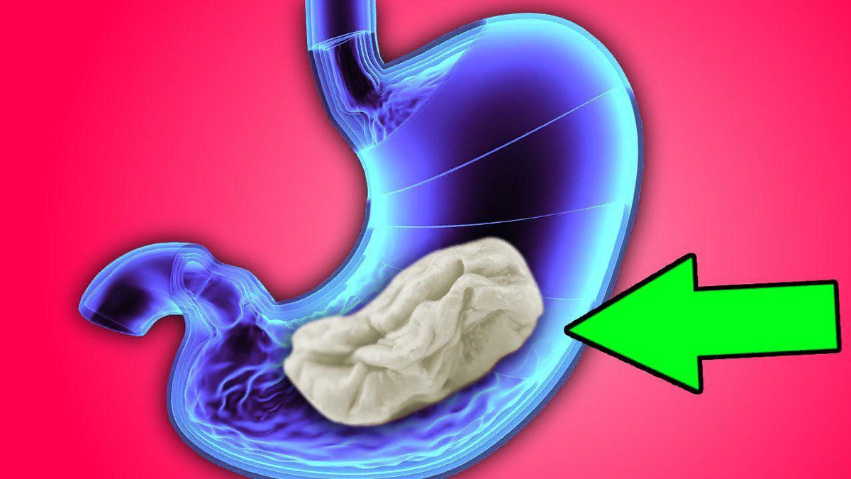 Ощущение застрять. Жевательная резинка в желудке.