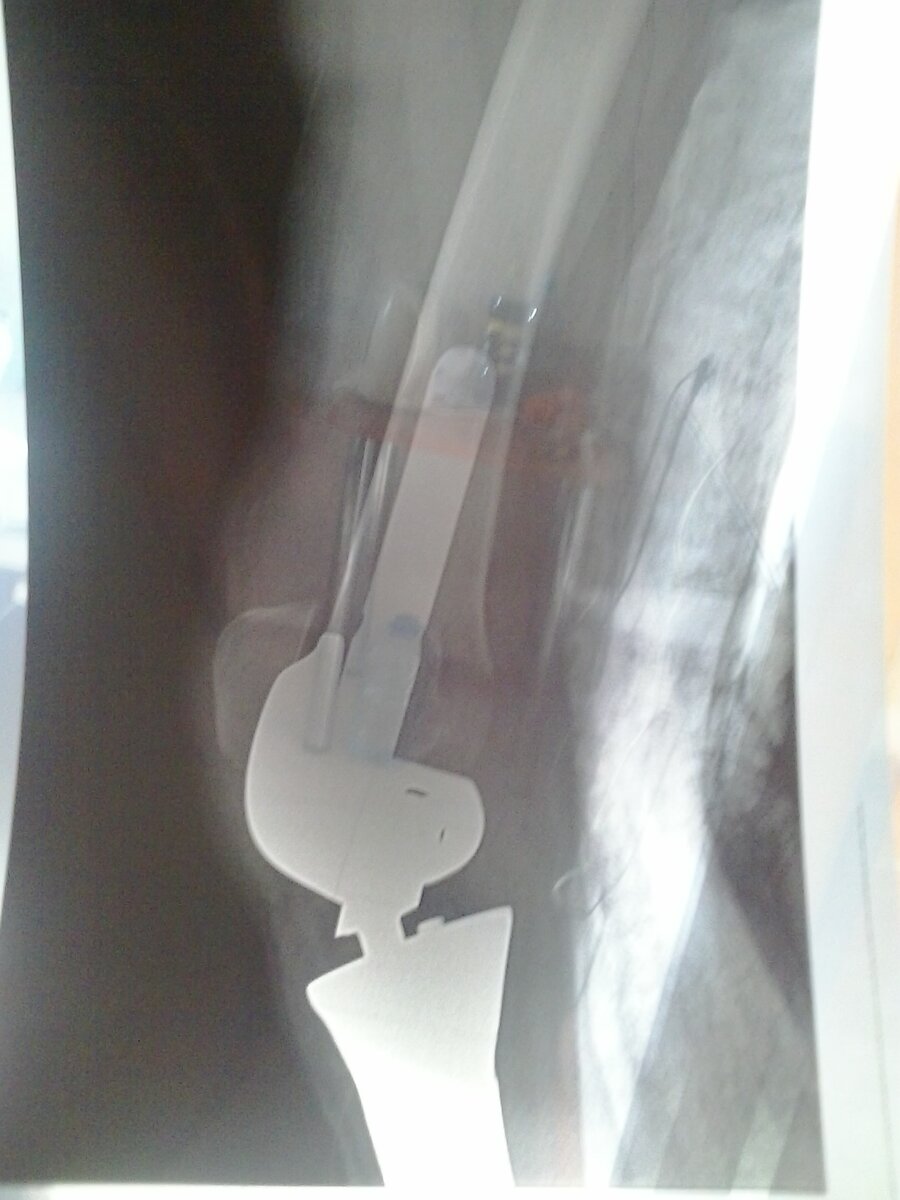 моя нога после первой операции (слабонервным не желательно смотреть галерею)