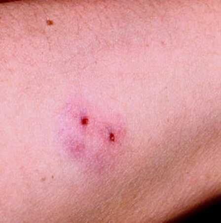 Проколы на кожной ткани от змеи