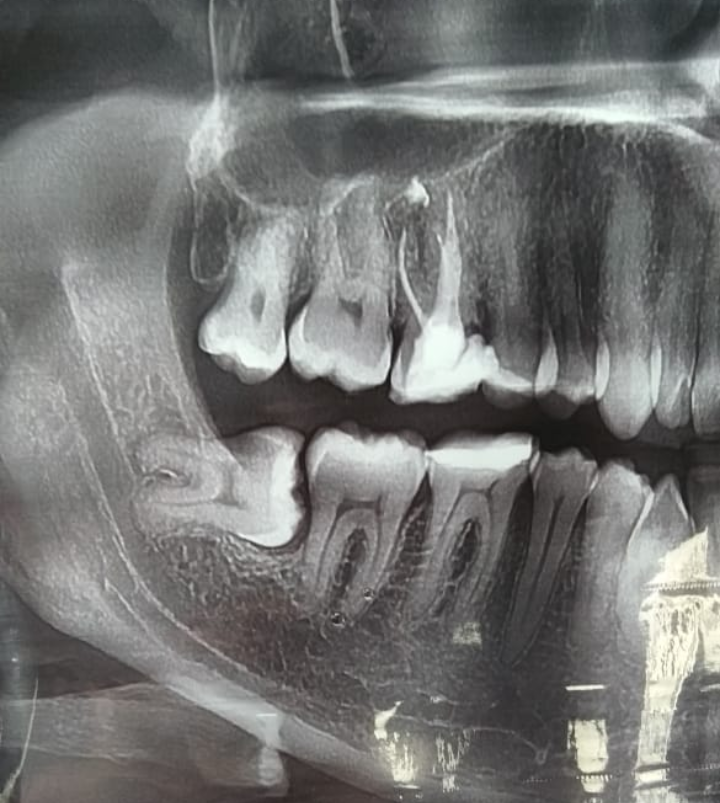 По какой причине вообще зубы мудрости нужно удалять? Является ли эта процедура безопасной? Следует ли вообще считать удаление решением проблемы? Грамотный стоматолог, безусловно, проведёт консультацию с пациентом, ответит на все его вопросы и постарается объяснить необходимость операции (или дальнейшего лечения, если в хирургическом вмешательстве нет необходимости).