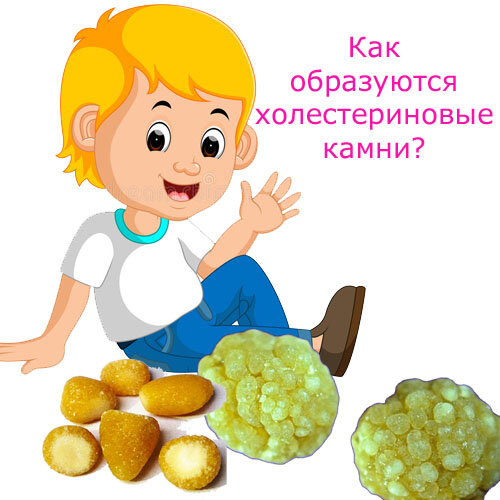 Как образуются холестериновые камни