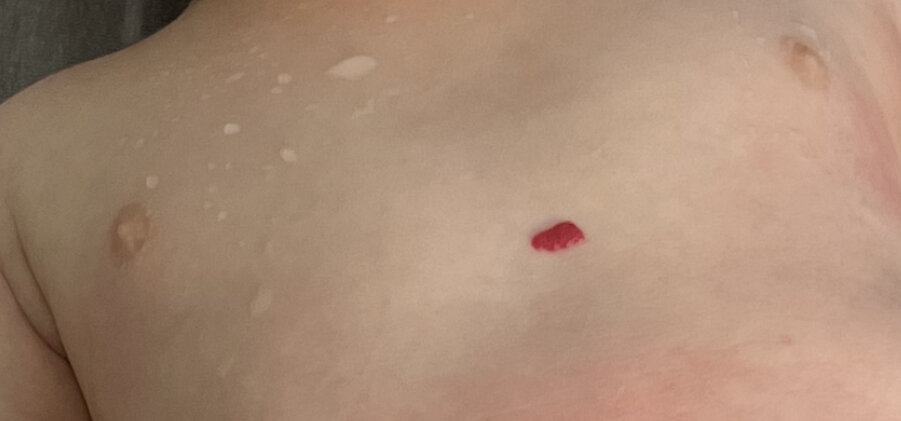 Гемангиоме 2,5 месяца, малышу 3,5 месяца