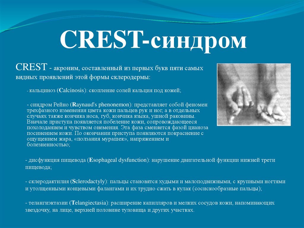 Синдром Рейно есть. Телеангиэктазия есть. Дисфункция пищевода начальная стадия есть. 