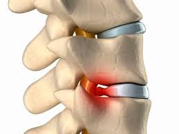 Радикулит — это воспаление одного из нервных корешков головы. Он начинает угасать в ясном, ясном небе: легкое неловкое движение приводит к сильной боли в спине. Каждый      восьмой человек старше 50 лет имеет статистически значимый риск.