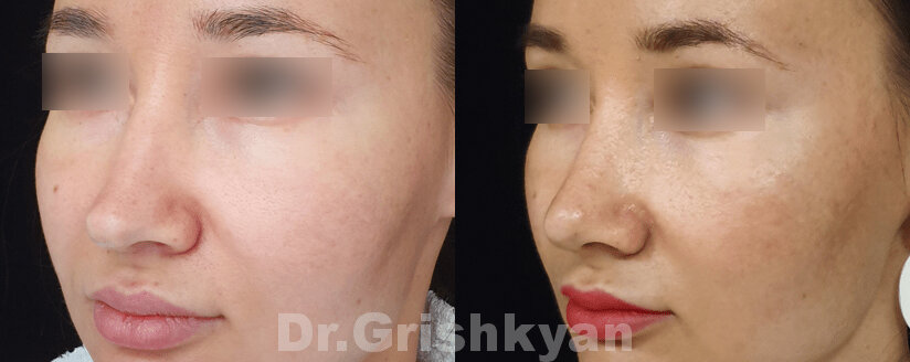 Пациентке проведена пластика кончика носа и липофилинг лица