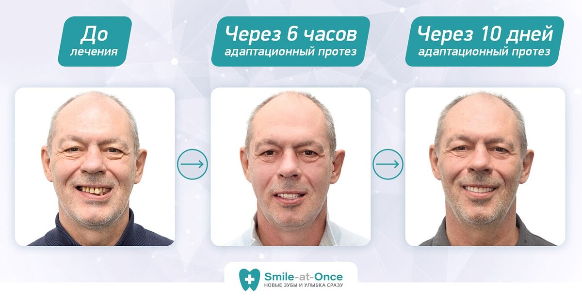 Игорь Каденко из г. Белгород мечтал об имплантации All-on-4 – и мы помогли ему исполнить мечту!