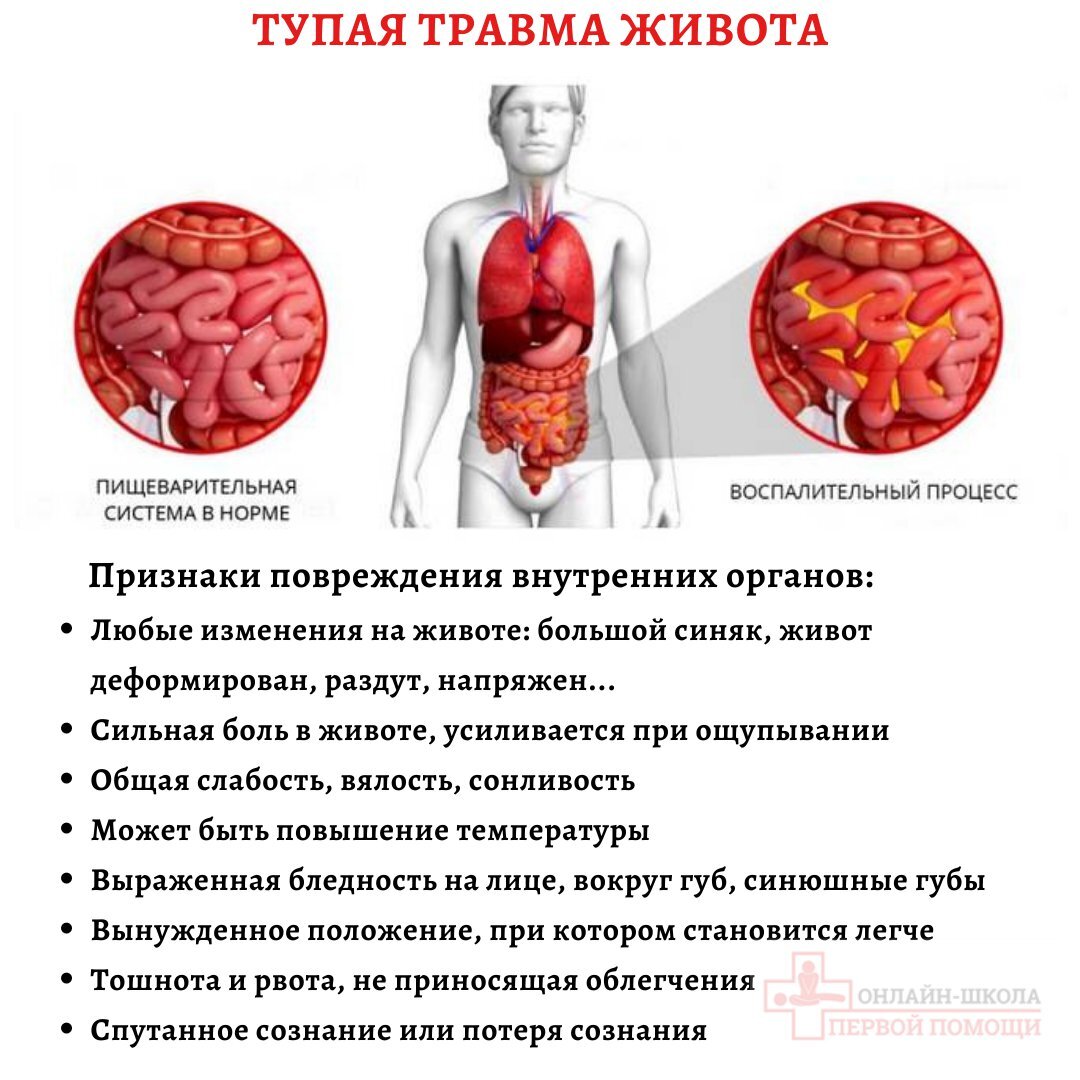 Что делать при тупой травме живота | Онлайн-школа первой помощи №1 | Дзен