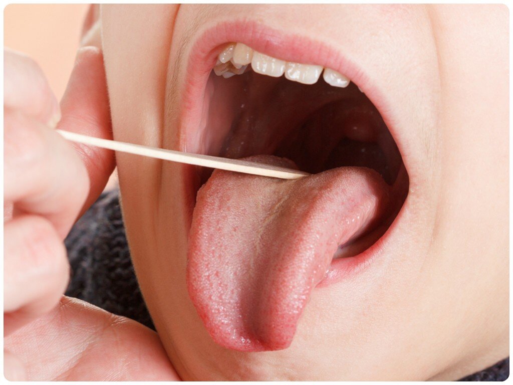 Чем полоскать горло при ангине и как лечить тонзиллит - Здравица