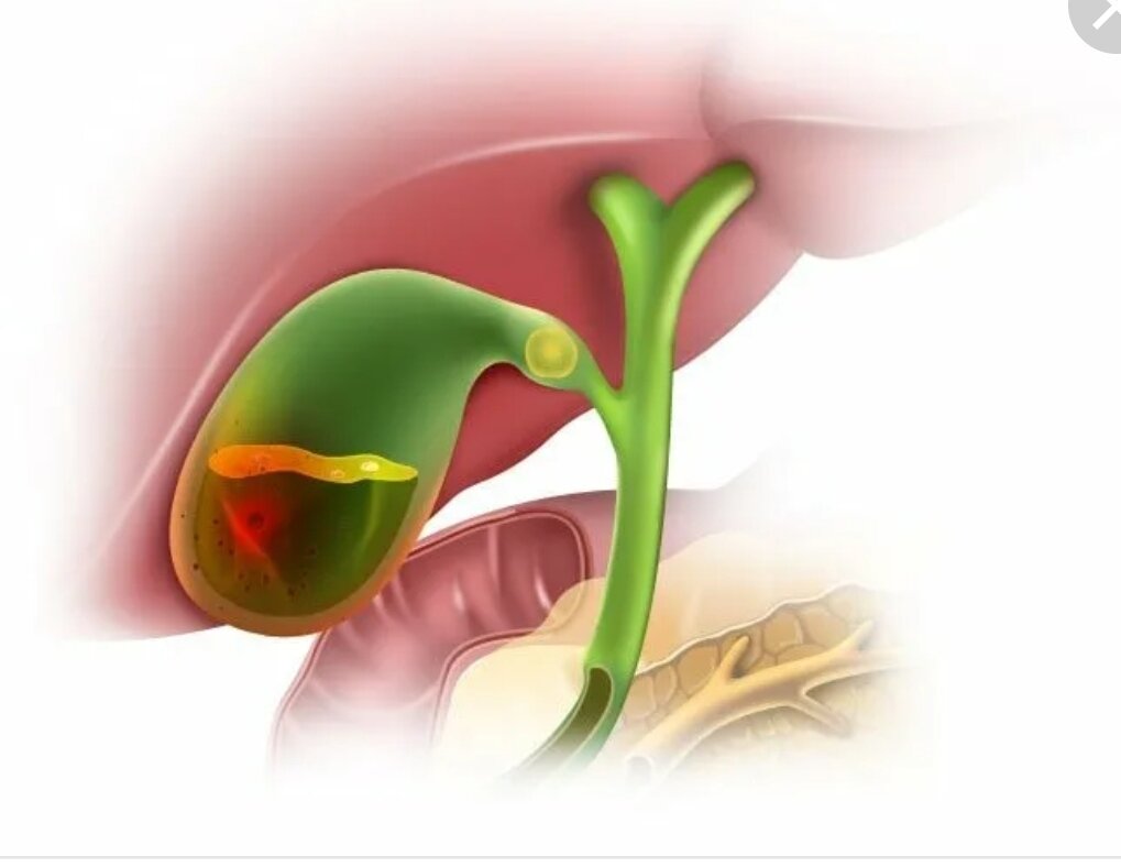 Острый холецистит желчного пузыря