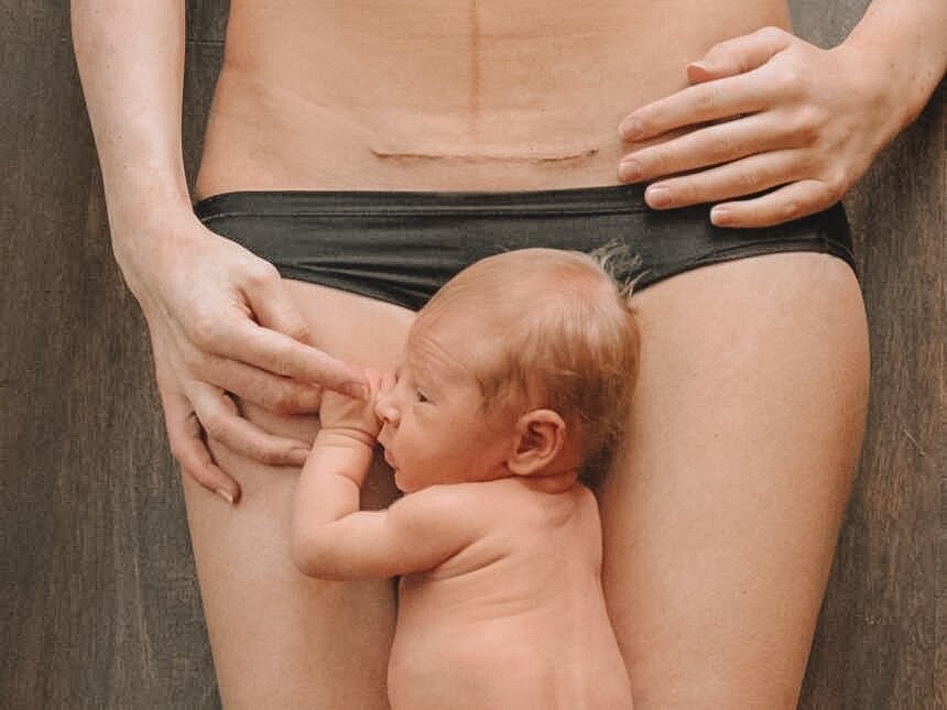 Кесарево сечение