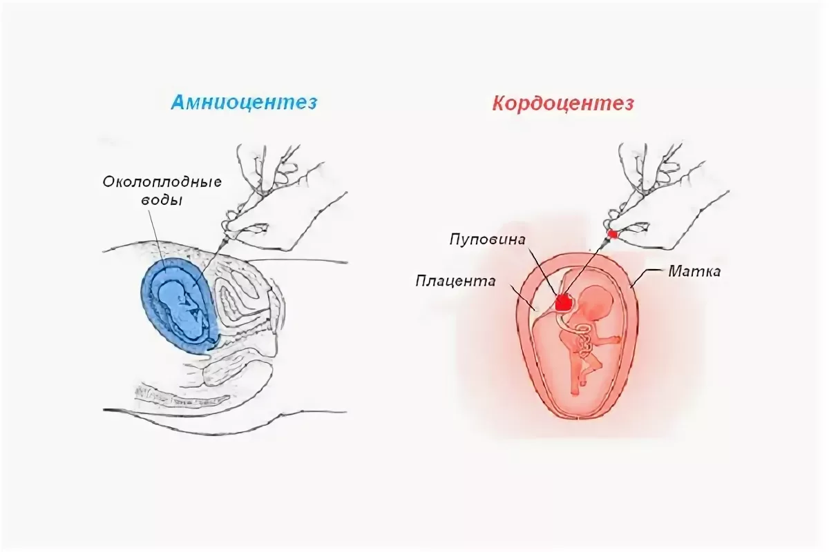 В каких случаях делают прокол живота у беременных? | Программа Мама | Дзен