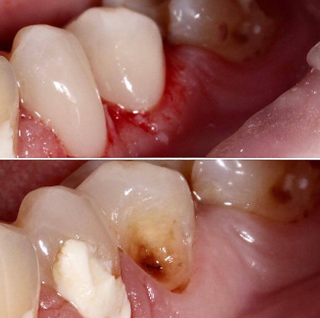  У Александры, молодой и красивой пациентки стоматологии Обнинска «Лазурит», был достаточно негативный опыт общения с зубными врачами. С детства, страдая из-за разрушения зубов, она была частым гостем у стоматологов. Реставрации постоянно выпадали и врачи, по словам Александры, утверждали, «что на таких поверхностях будут стоять только цементные пломбы», которые эстетикой не отличались.
Дойдя, наконец, до «Лазурита», Александра поняла, что «красиво» решить ее проблему все-таки можно! Результат лечения вы видите на фото.
- Многие наши пациенты почему-то уверены, что пришеечные дефекты вообще не лечатся. Конечно, это не так! Все дело в качестве материалов и оборудования и, конечно, в профессиональном уровне доктора! - комментирует заместитель главного врача Дина Коркунова, - Поэтому еще раз призываю всех, кто нас читает – если у вас появляются вопросы и сомнения, приходите на консультацию к специалисту и обсудите это с ним! И многие проблемы будут решены в спокойном будничном режиме!