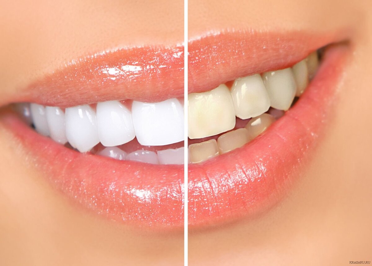 Отбеливание зубов в домашних условиях - Стоматология Smile
