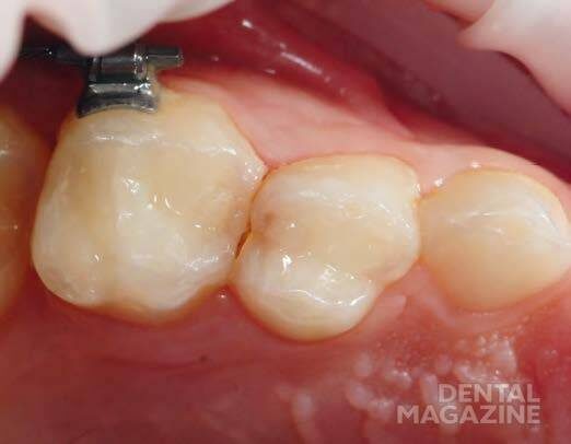 Рис. 1. Исходная ситуация: зуб 54 с дистальным кариесом.