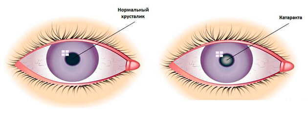 Основном симптом катаракты - помутнение хрусталика