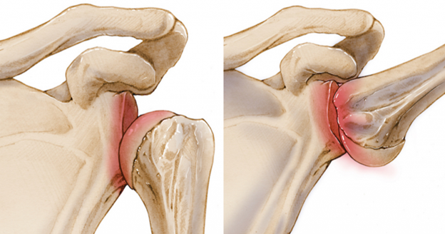 Важная функция этого подворачивания заключается в том, что головка плечевой кости опущена от акромиона.  