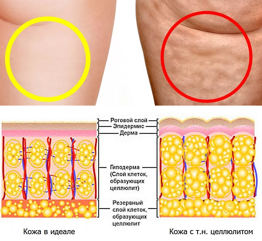 Сравнение гладкой кожи в разрезе и кожи с целлюлитом