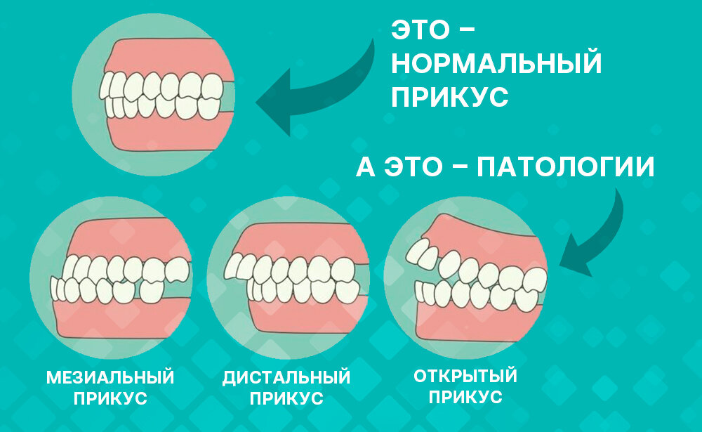 Прогенический прикус в стоматологии называют мезиальным, а прогнатический – дистальным. Фото: Smile-at-Once.ru. 