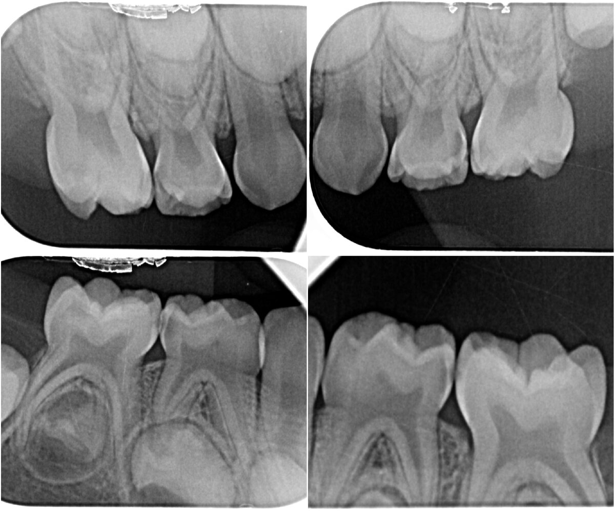 Вот так выглядит комплекс прицельных снимков жевательной группы зубов (4 штуки). Видны все корни, кость между корнями и вокруг них, все поверхности зуба, нет наложения проекции одного зуба на другой.