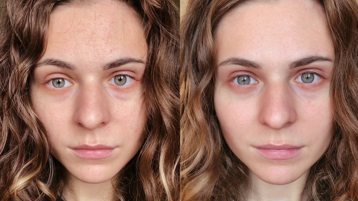 Мой результат до и после применения комплекса антиакне BIOAQUA  Pure Skin