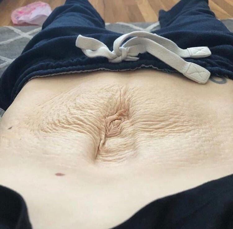 Диастаз прямых мышц живота 