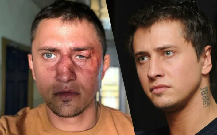 Прилучный до и после операции на уши Карина и павел прилучный фото, видео