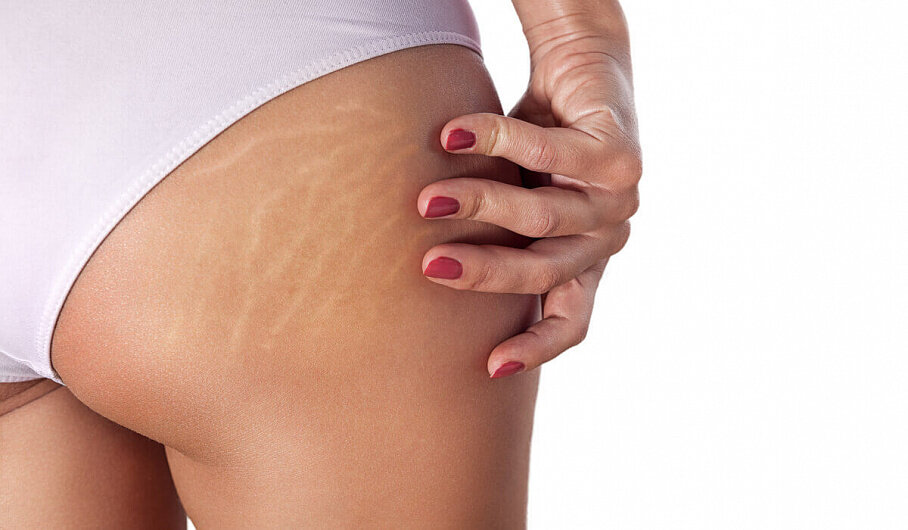 Растяжки - это чисто косметическая проблема. К счастью, эту проблему очень просто решить.
(Изображение взято с сервиса Яндекс.Картинки)