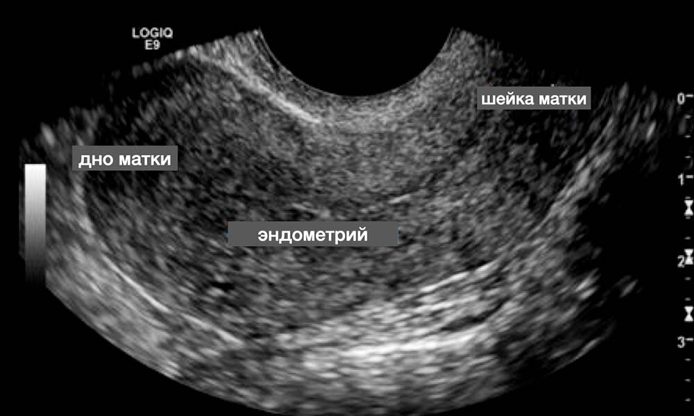УЗИ снимок матки