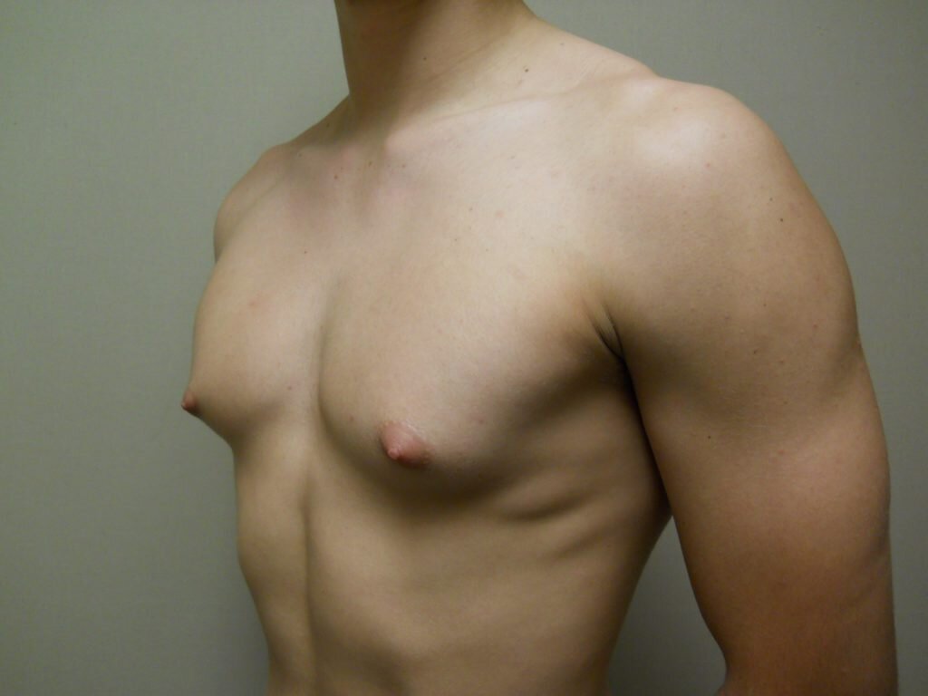 Гинекомастия: рост груди у мужчин | МедИнфо | Дзен