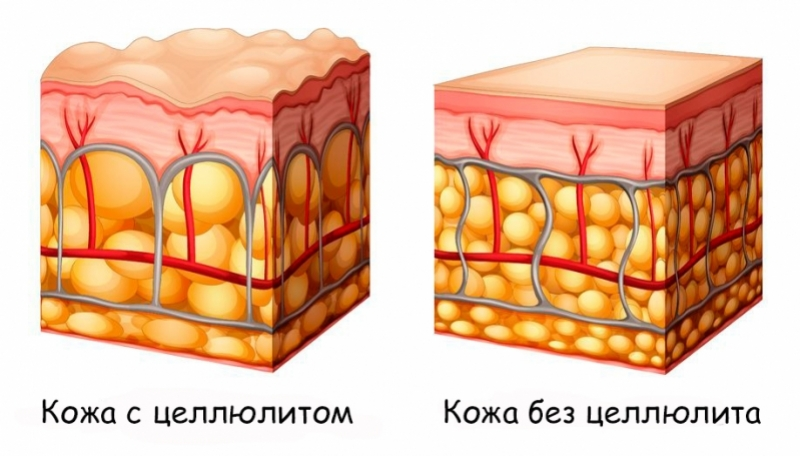 На фото выше видна разница кожи с "целлюлитом" и без. Основная причина возникновения "целлюлита" — нарушение кровоснабжения, его замедление, из-за чего клетки организма недополучают кислород и необходимые ему питательные вещества. В том месте, где клетки голодают, они накапливают жир, вместе с токсинами и вредными веществами, которые в свою очередь также не выводятся из-за замедленного кровоснабжения.