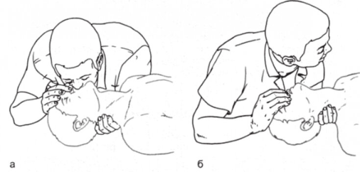 Искусственное дыхание методом рот ко рту осуществляется