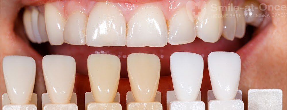 Тонкие несъемные накладки на зубы создаются из разных материалов. От этого зависит их прочность, долговечность, внешний вид и, конечно же, цена. Фото: Smile-at-Once.ru.