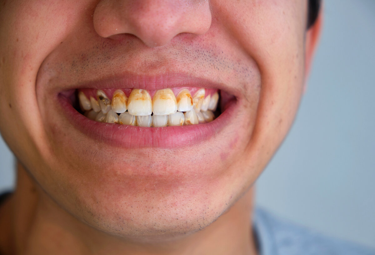 Как сохранить зубы здоровыми: 5 советов от стоматолога