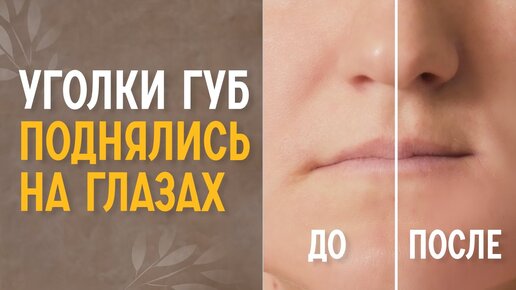 Как поднять уголки губ тейпами схема