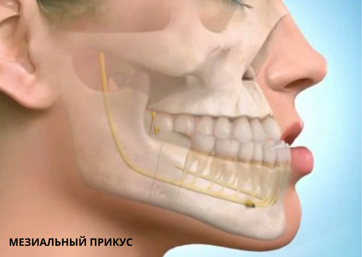 Почему сжата челюсть. Мезиальный прикус нижней челюсти. (Прогенический мезиальный прикус). Мезиальный прикус челюсть. Мезиальный прикус операция.