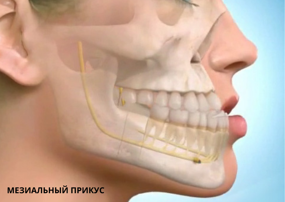 Прогения нижней. Мезиальный прикус нижней челюсти. (Прогенический мезиальный прикус). Ортогнатия мезиальный прикус. Мезиальный прикус операция.