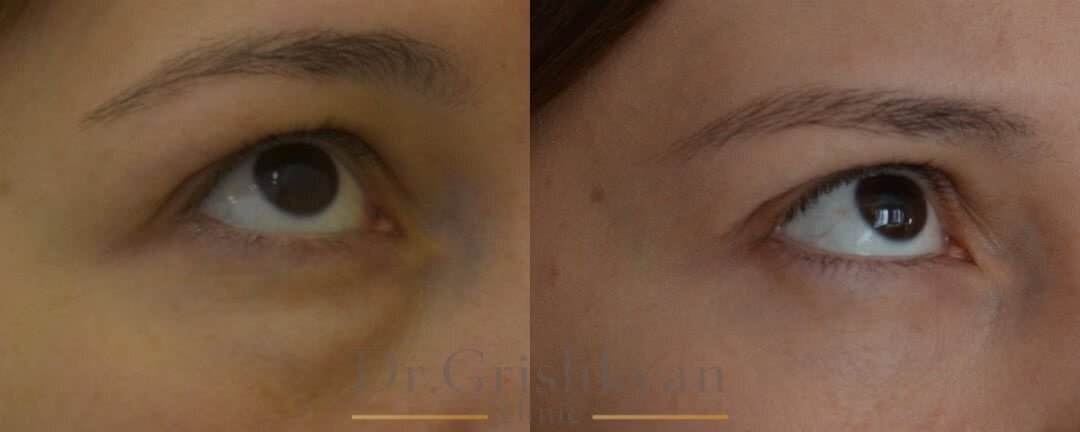 Блефаропластика нижнего века фото до и после. Фото с сайта Д.Р. Гришкяна. Имеются противопоказания, требуется консультация специалиста