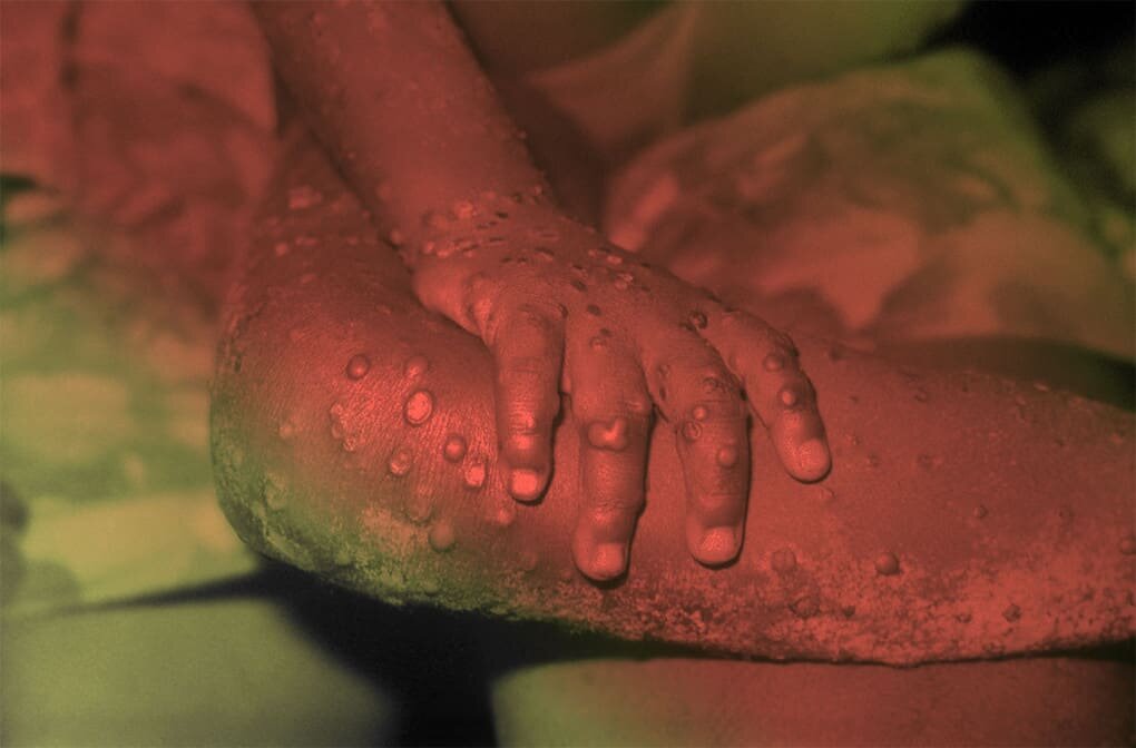 Поражено людей: –Основные локализации заболевания: Весь мирВозбудитель заболевания: Variola major, Variola minorПричина возникновения: природно-очаговый вирусВозможное лечение: этиотропное или патогенетическое лечение 