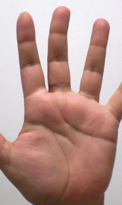 Кривой средний палец на руке. Искривление среднего пальца. Большой палец изгиб