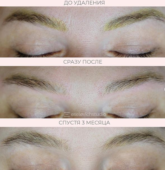 Некачественный татуаж бровей. Instagram eselevich_natalya