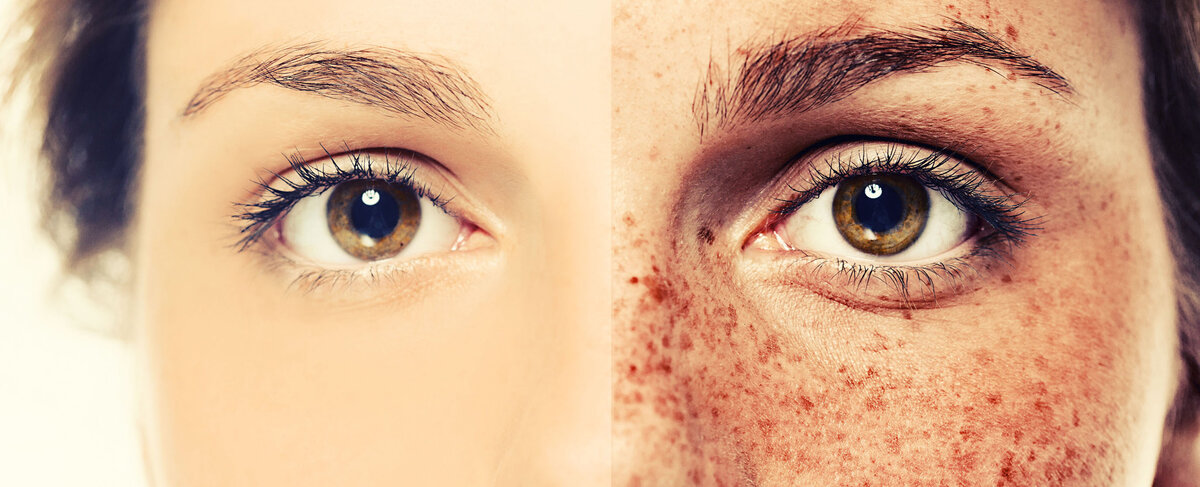 Пигментация на лице. Причины и методы борьбы