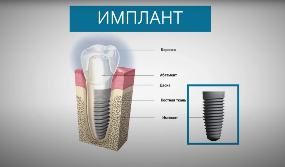 Имплант из какого материала