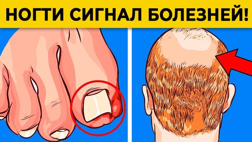 Как определить болезнь по ногтям? | Ногти скажут ВСЁ о вашем здоровье!