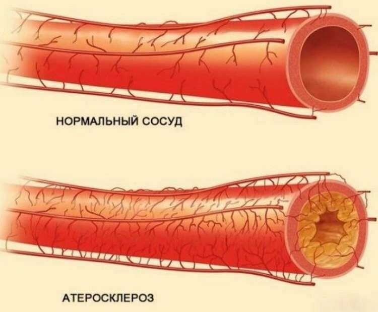 Атеросклероз сосудов: что это такое