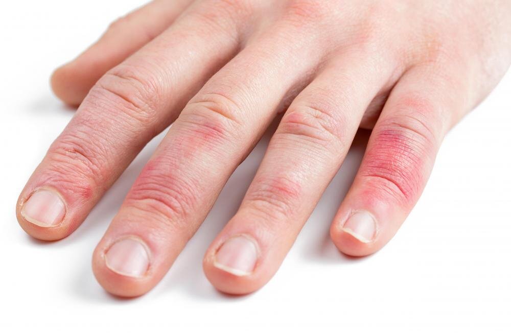 Авитаминоз